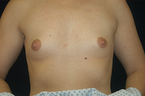 Breast Augmentation 2a